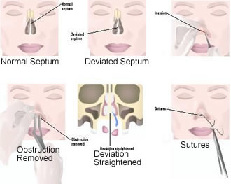 Septoplasty